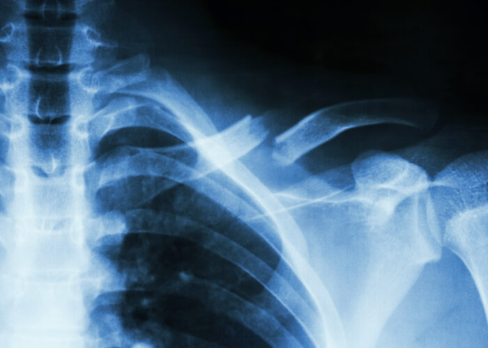 Fracture left clavicle